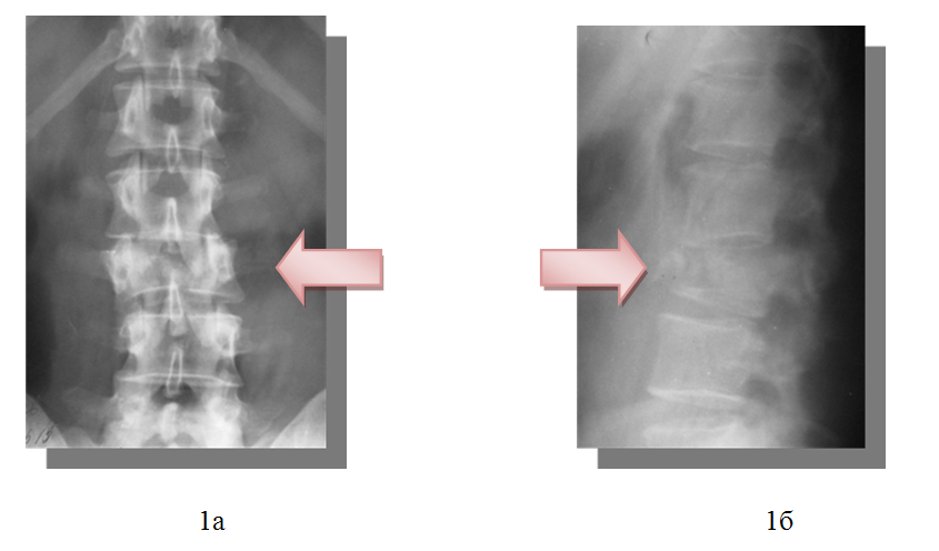 Рентгенограммы позвоночника пациента при поступлении