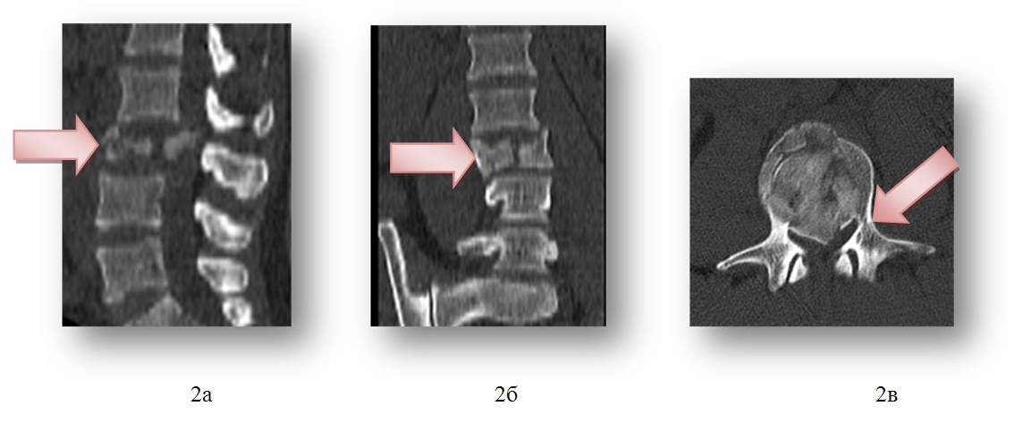 Компьютерные томограммы позвоночника