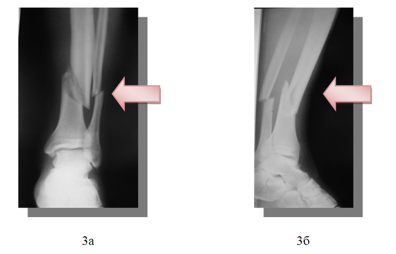 Компьютерные томограммы позвоночника