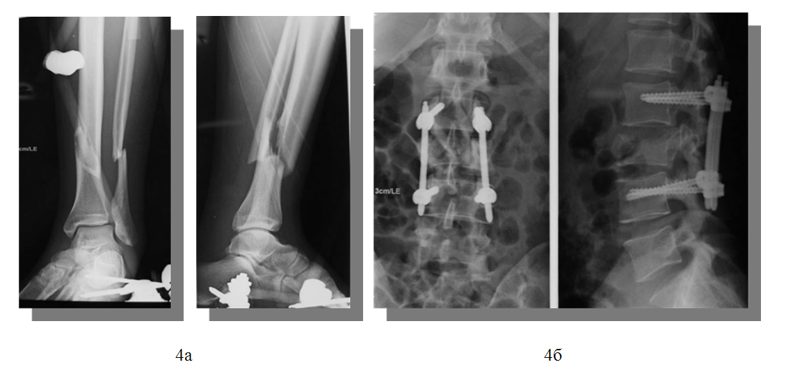Компьютерные томограммы позвоночника