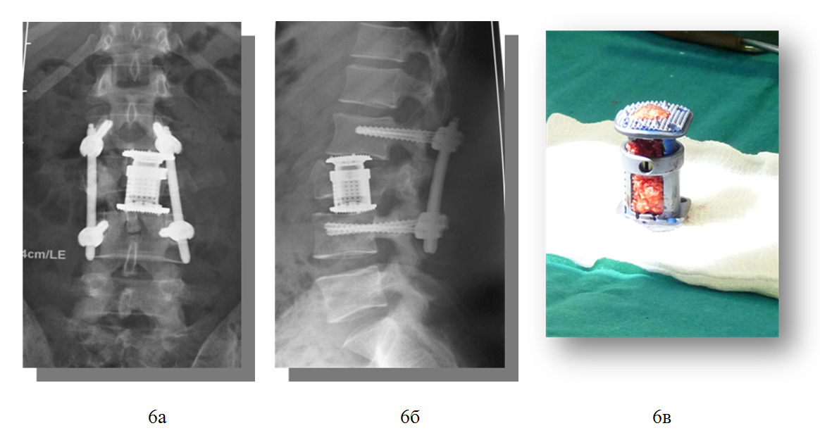 Рентгенограммы позвоночника