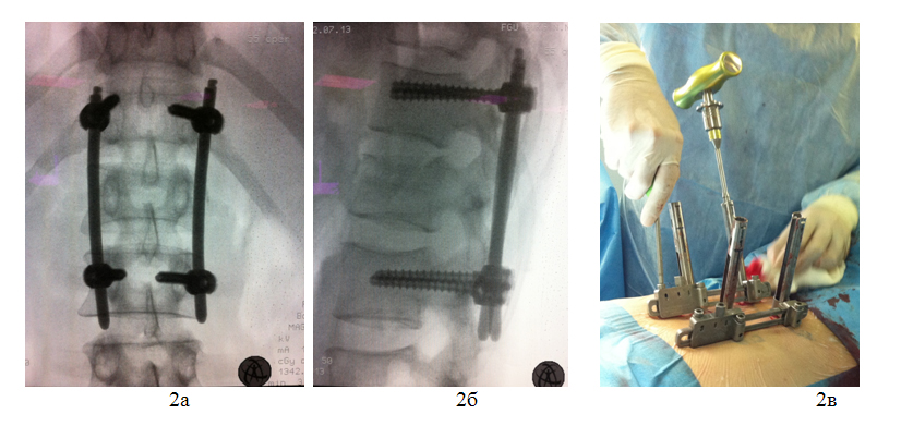 Интраоперационные рентгенограммы позвоночника в прямой (а) и боковой (б) проекциях