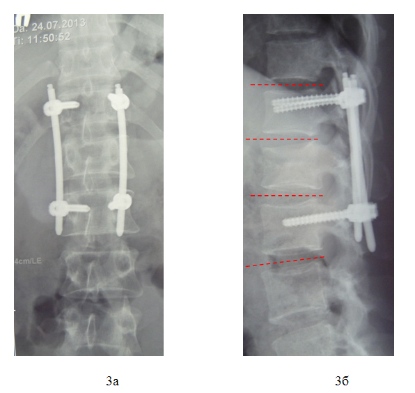 Рентгенограммы позвоночника после операции в прямой (а) и боковой (б) проекциях.