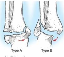 Типы переломов лодыжек - А