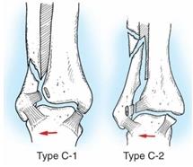 Типы переломов лодыжек - Б