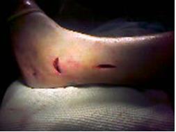 Рис. 5 (б) малоинвазивный доступ