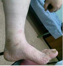 Рис. 6 (б) Результат через 6 недель после операции