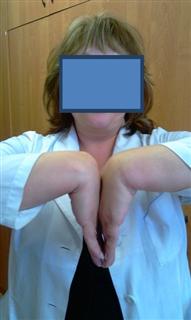 Рис. 10-а. Функциональный результат через 6 недель после операции