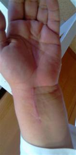 Рис. 10-б. Функциональный результат через 6 недель после операции