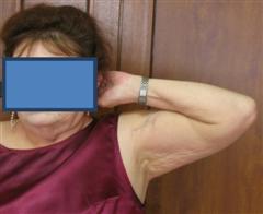 Рис.2-а. Через 4 месяца после операции (функция конечности)