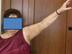 Рис.2-б. Через 4 месяца после операции (функция конечности)