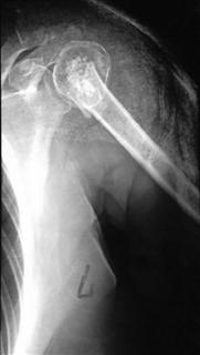 Рис.3-а Оскольчатый перелом проксимального эпифиза плечевой кости до операции