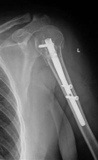 Рис.3-б Оскольчатый перелом проксимального эпифиза плечевой кости после операции