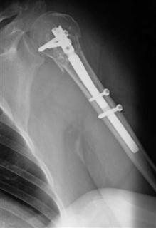 Рис.3-в Оскольчатый перелом проксимального эпифиза плечевой кости после операции