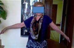 Рис. 4. Функциональный результат через 14 суток после операции