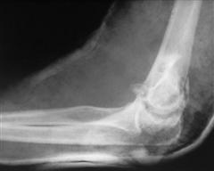 Рис. 5-а. Оскольчатый внутрисуставной перелом дистального эпифиза плечевой кости до операции)