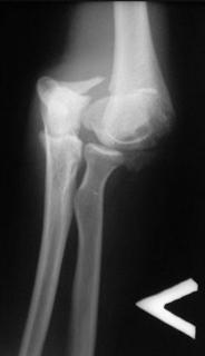 Рис. 5-б. Оскольчатый внутрисуставной перелом дистального эпифиза плечевой кости до операции)