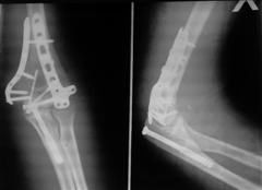 Рис. 5-в. Оскольчатый внутрисуставной перелом дистального эпифиза плечевой кости после операции)