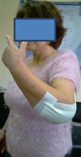 Рис.6-а. Функциональный результат через 10 суток после операции