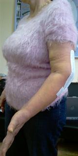 Рис.6-б. Функциональный результат через 10 суток после операции