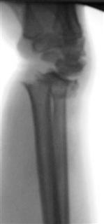 Рис.9-а Оскольчатый перелом лучевой кости до операции