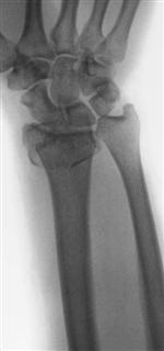 Рис.9-б Оскольчатый перелом лучевой кости до операции