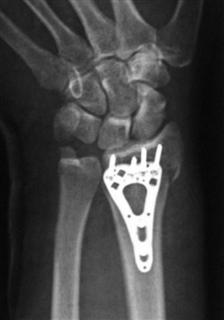 Рис.9-г Оскольчатый перелом лучевой кости после операции