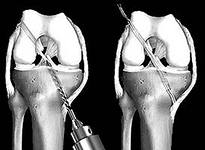 Трансплантат передней