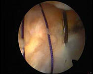 Артроскопическая