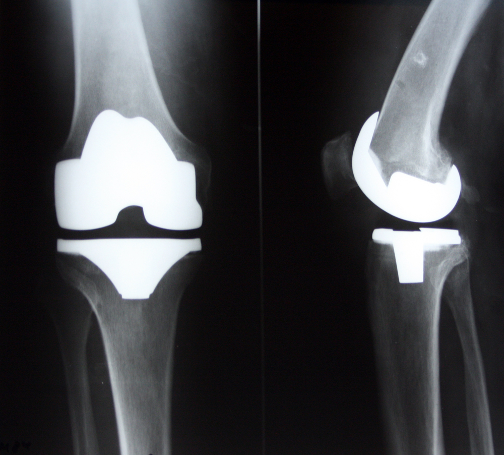 Эндопротезирование