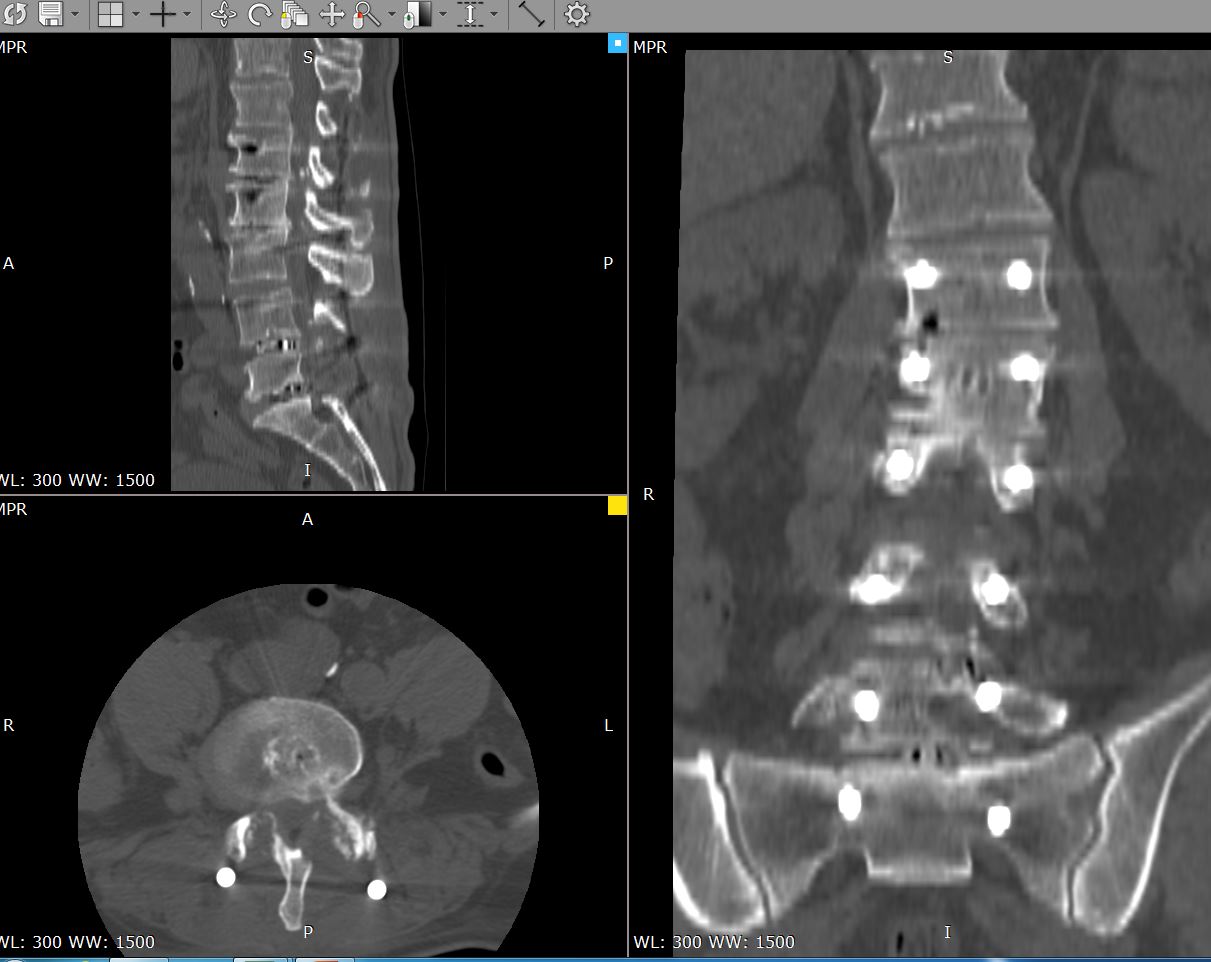 Многоуровневый стеноз КТ после операции