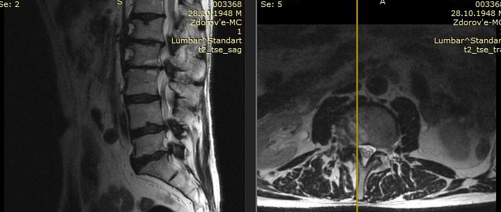 Многоуровневый стеноз МРТ до операции