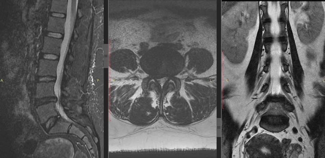 МРТ Грыжи поясничного отдела L4-L5 справа