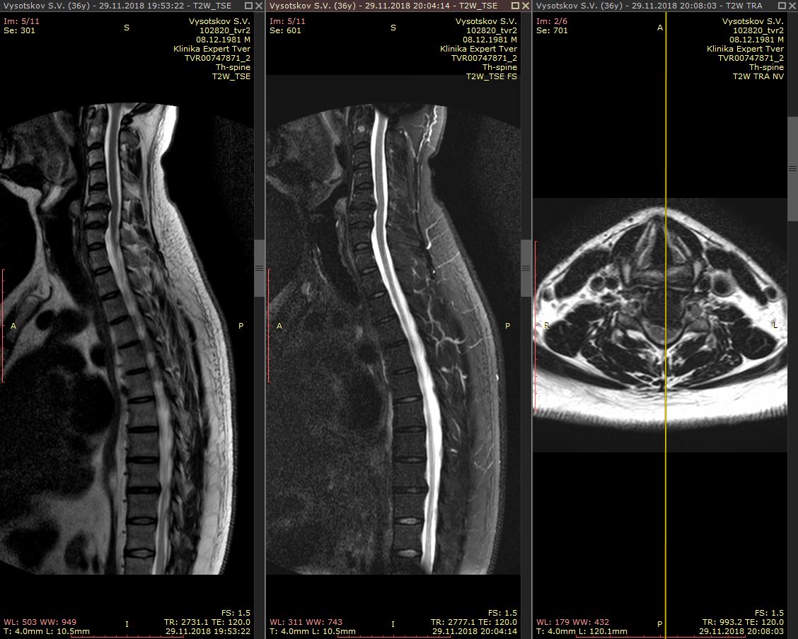 МРТ грыжи шейного отдела позвоночника