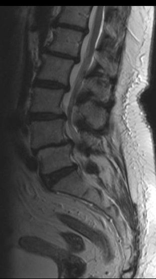 МРТ Многоуровненвый стеноз Нестабильность L3-L4