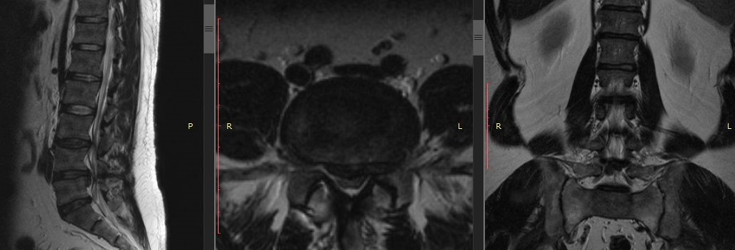 МРТ Многоуровневый стеноз