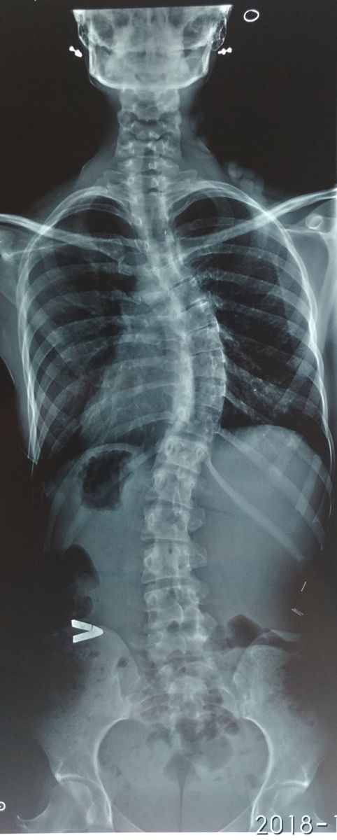 Сколиоз Постуральный рентген