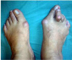 Общий вид стопы при различных деформациях пальцев