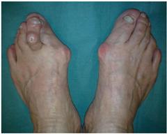 Общий вид стопы при различных деформациях пальцев