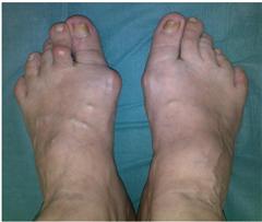 Общий вид стопы при различных деформациях пальцев