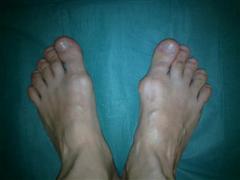 Внешний вид стоп до операции