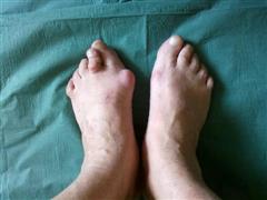 Внешний вид стоп до операции