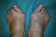 Внешний вид стоп до операции