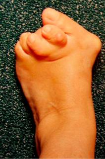 Внешний вид стоп до операции