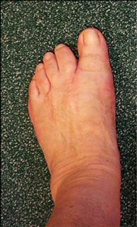 Внешний вид стоп до операции