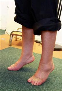 Внешний вид стоп до операции