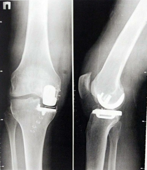Операция по замене коленного сустава