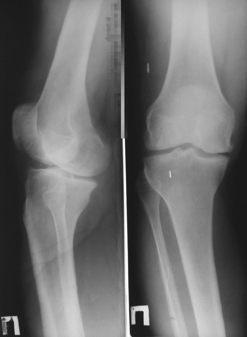 Замена коленного сустава